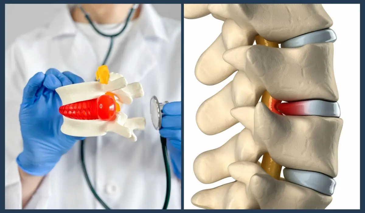 Medical model and anatomical diagram illustrating herniated vs. bulging discs, highlighting spinal disc structure and nerve compression points.