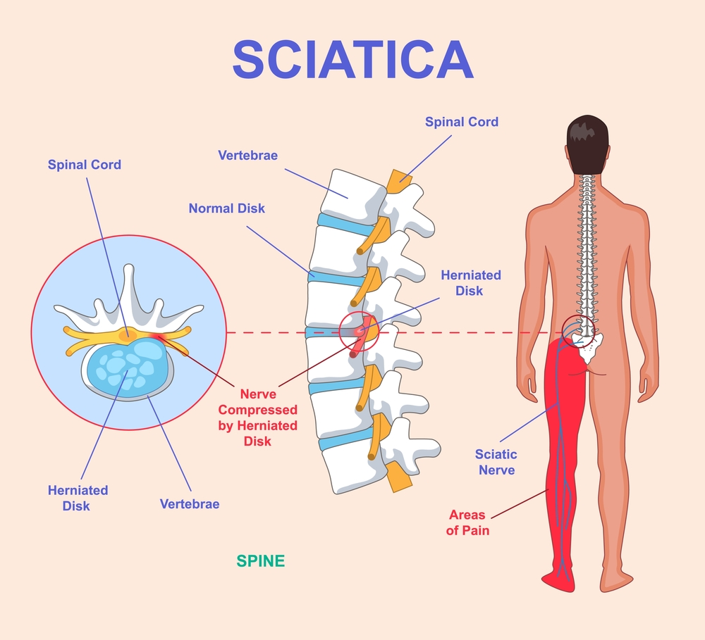 Medical illustration of sciatica showing a herniated disc compressing a spinal nerve, with a red highlight indicating the path of pain down the leg.