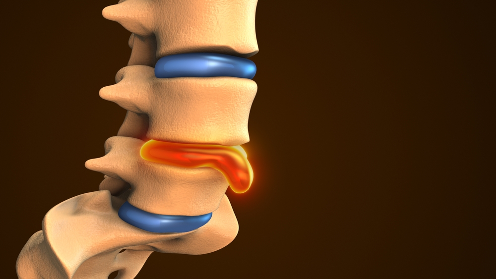 3D anatomical model of a human lumbar spine showing a glowing orange herniated disc protruding between two vertebrae.
