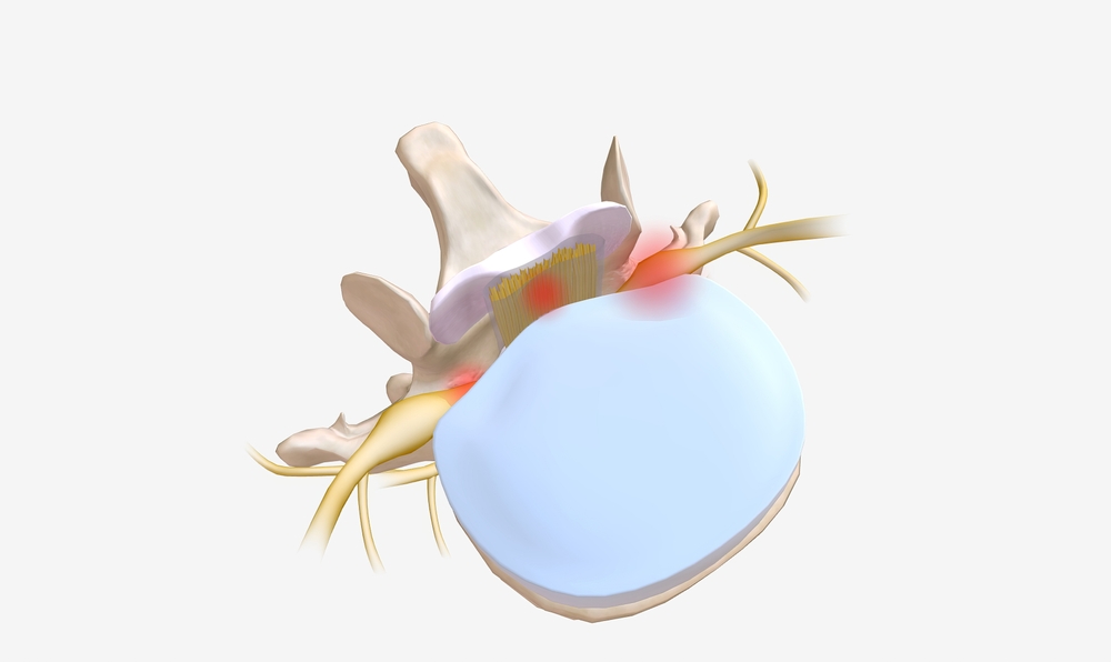 A top-down anatomical cross-section of a lumbar vertebra and intervertebral disc, showing a disc bulge pressing against a spinal nerve root with red glowing highlights indicating the site of pain.