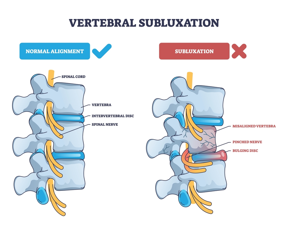 Medical illustration comparing normal vertebral alignment with a subluxation, showing a misaligned vertebra, pinched nerve, and bulging disc.