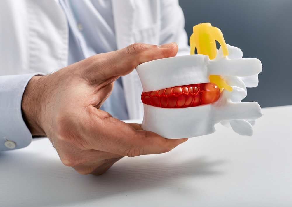 A chiropractor or doctor holding a white anatomical spine model showing a red bulging disc between two vertebrae to demonstrate nerve compression.