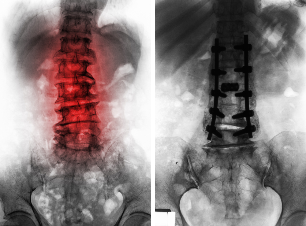 Side-by-side spinal X-rays: the left image shows a lumbar spine with red highlights indicating inflammation and disc degeneration; the right image shows a lumbar spine after surgery with metal rods and screws for spinal fusion.