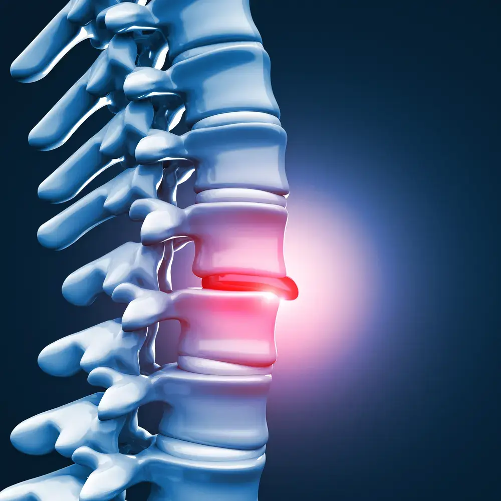 Disc Injury Conditions Treatment Chiropractor Arlington Heights, IL
